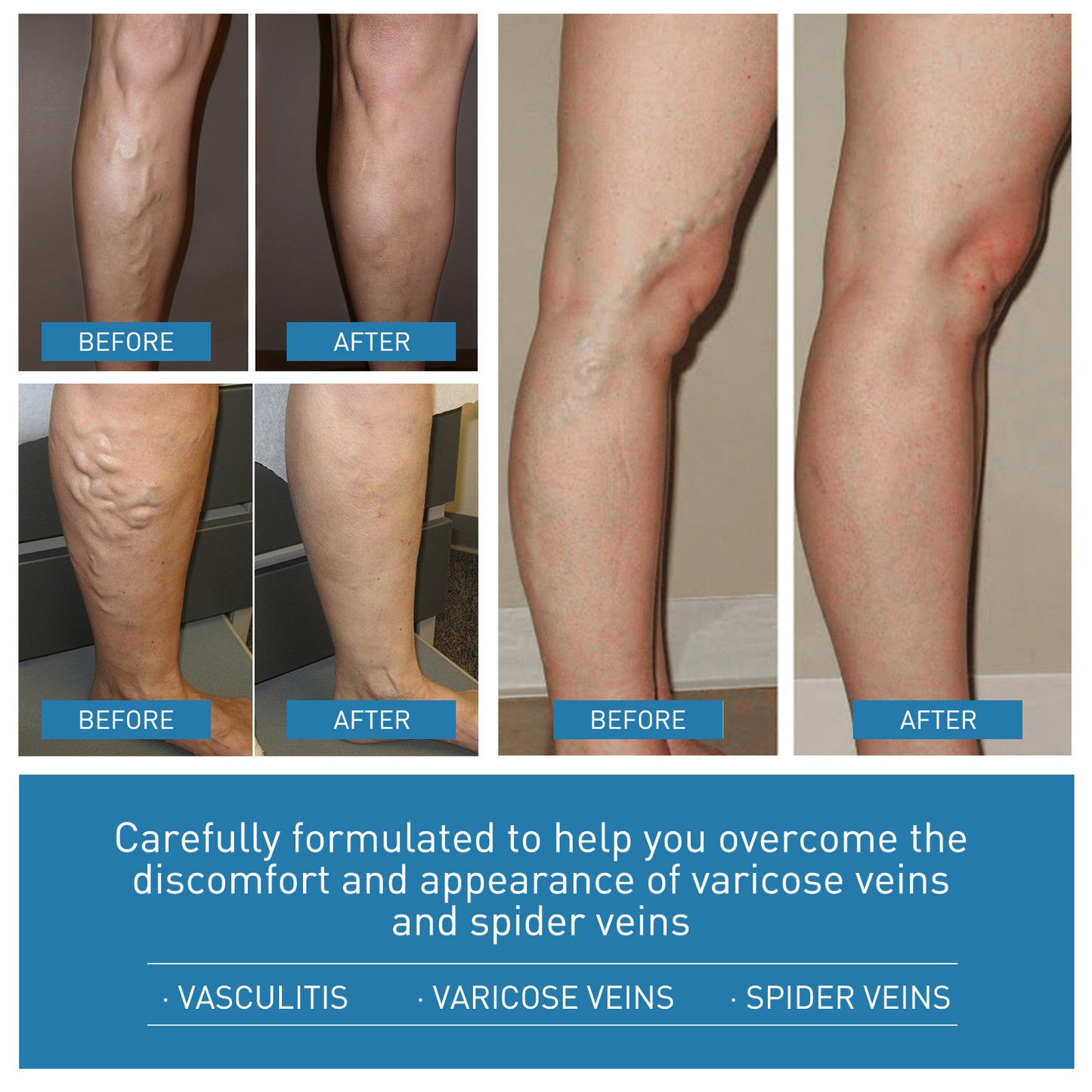 VitalVenen | Vein Repair Cream Massage